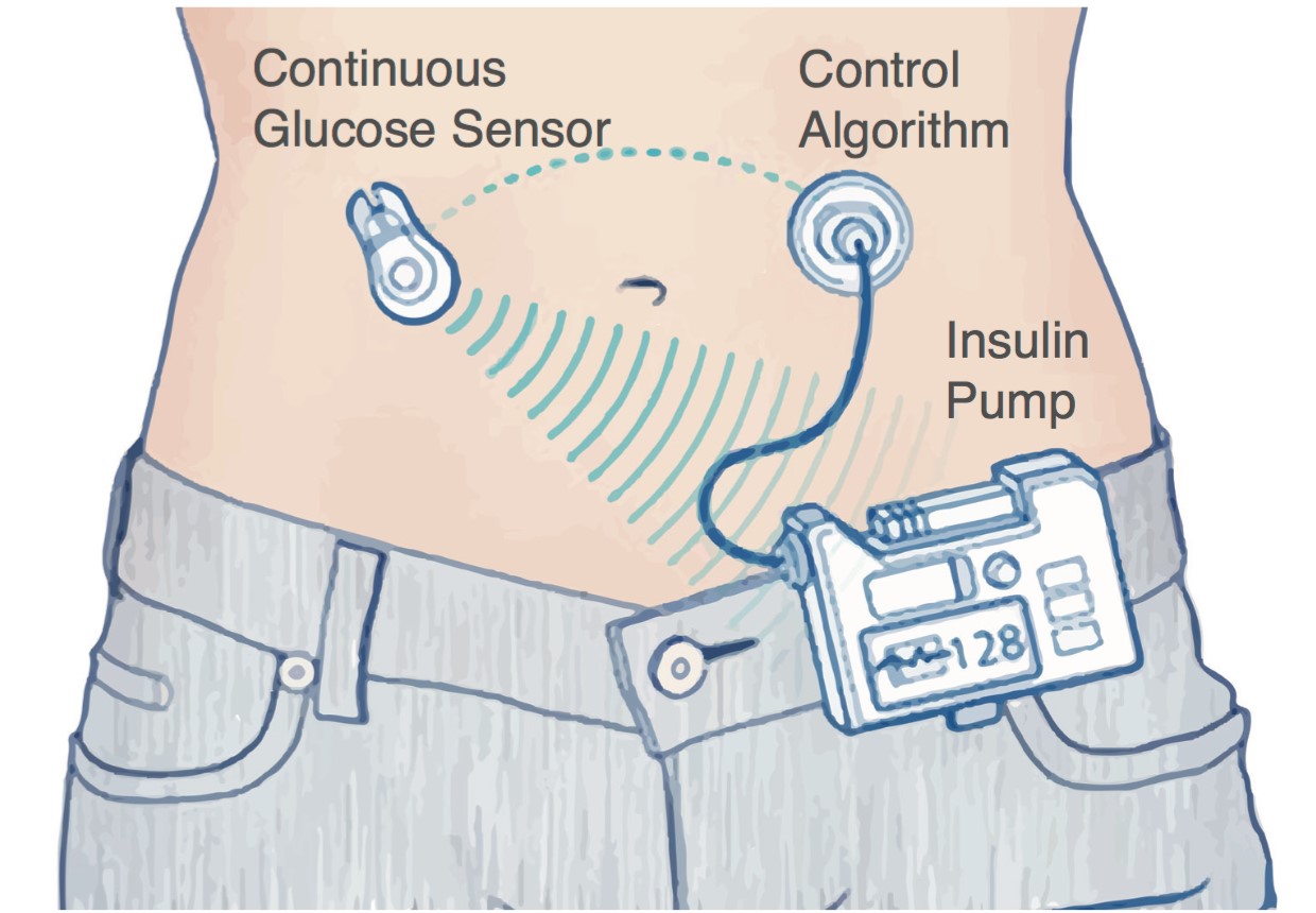 Breakthroughs in Implantable Programmable Pump (IPP) Technology
